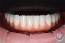 Протезування зубів - імплантація
