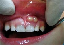 WHAT IS A TOOTH CYST?