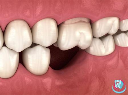 Остеопластика в стоматологии — причины, по которым может возникать дефицит костной ткани: