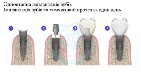 Методики установки стоматологических имплантатов