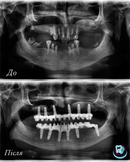 Преимущества зубных титановых имплантов
