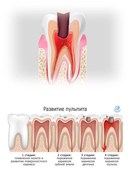Types of pulpitis:
