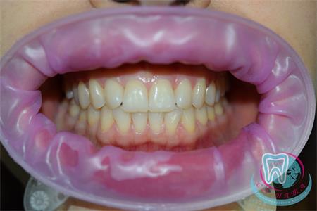 How is laser whitening performed?