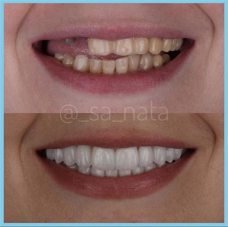 Керамическая реставрация E.MAX; Съемный протез на имплантах; КОРОНКА; Цифровое сканирование зубов - 3Shape; Виниры.
