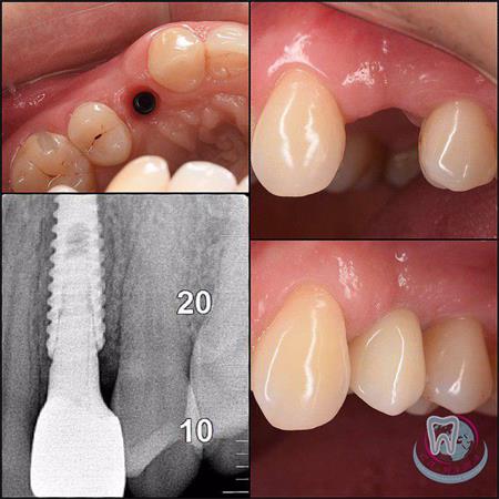 How does implantation take place? Stages of dental implantation in Sa-Nata