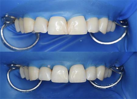 Характерные отличия между художественной реставрацией зубов и установкой виниров: