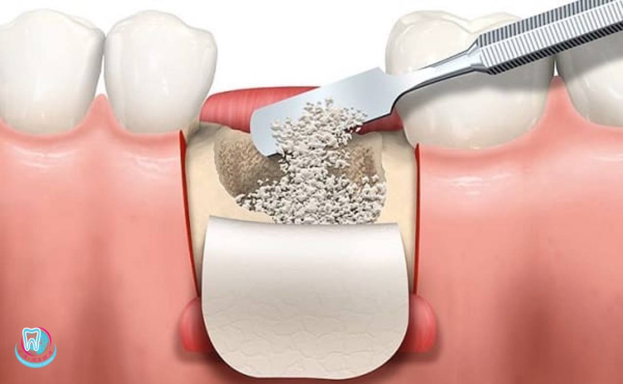 Остеопластика в стоматологии в Киеве - наращивание костной ткани зуба, цена  услуги в стоматологии sa-nata.com.ua