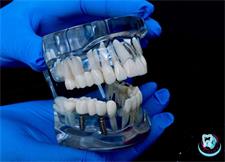 Качественная имплантация зубов