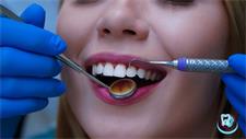 Фторування зубів