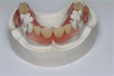 Знімне протезування зубів