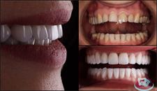 Porcelain veneers the prices are the lowest in the region