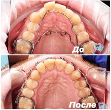 Non-removal orthodontic appliances