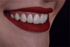 Лазерное лечение в стоматологии — преимущества:
