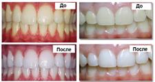Teeth Whitening in Dentistry