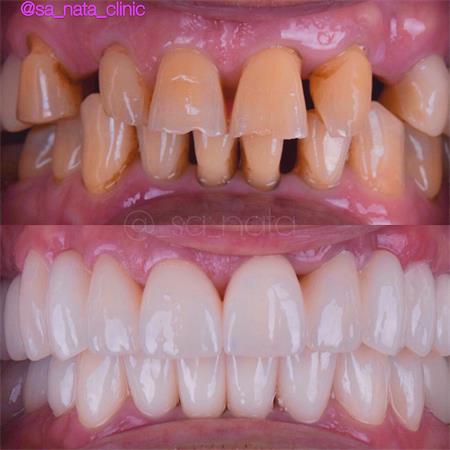 Имплантология в современной стоматологической медицине