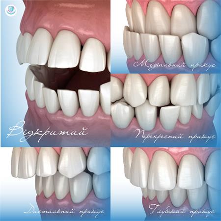 Прием стоматолога ортодонта — типы неправильного прикуса