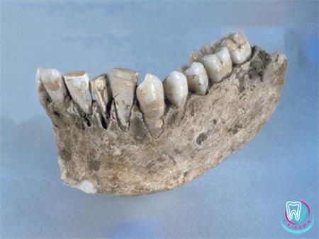 Історія виникнення зубних імплантів