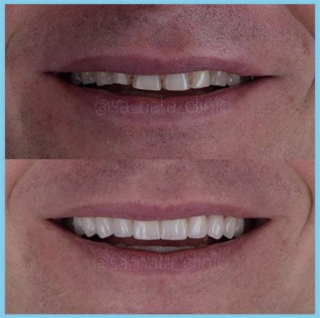 Керамическая реставрация E.MAX; Съемный протез на имплантах; КОРОНКА; Цифровое сканирование зубов - 3Shape; Виниры.
