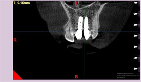 Компьютерная томография зуба  — оборудование для проведения обследования
