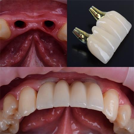 Імплантологія в сучасній стоматологічній медицині