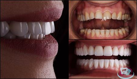 Керамические виниры на зубы (ортопедическая стоматология) — современное решение для каждого!