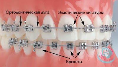 How are braces installed?