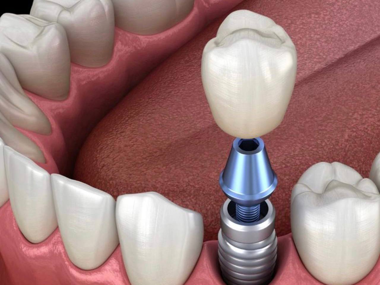 Составляющие зубного имплантата
