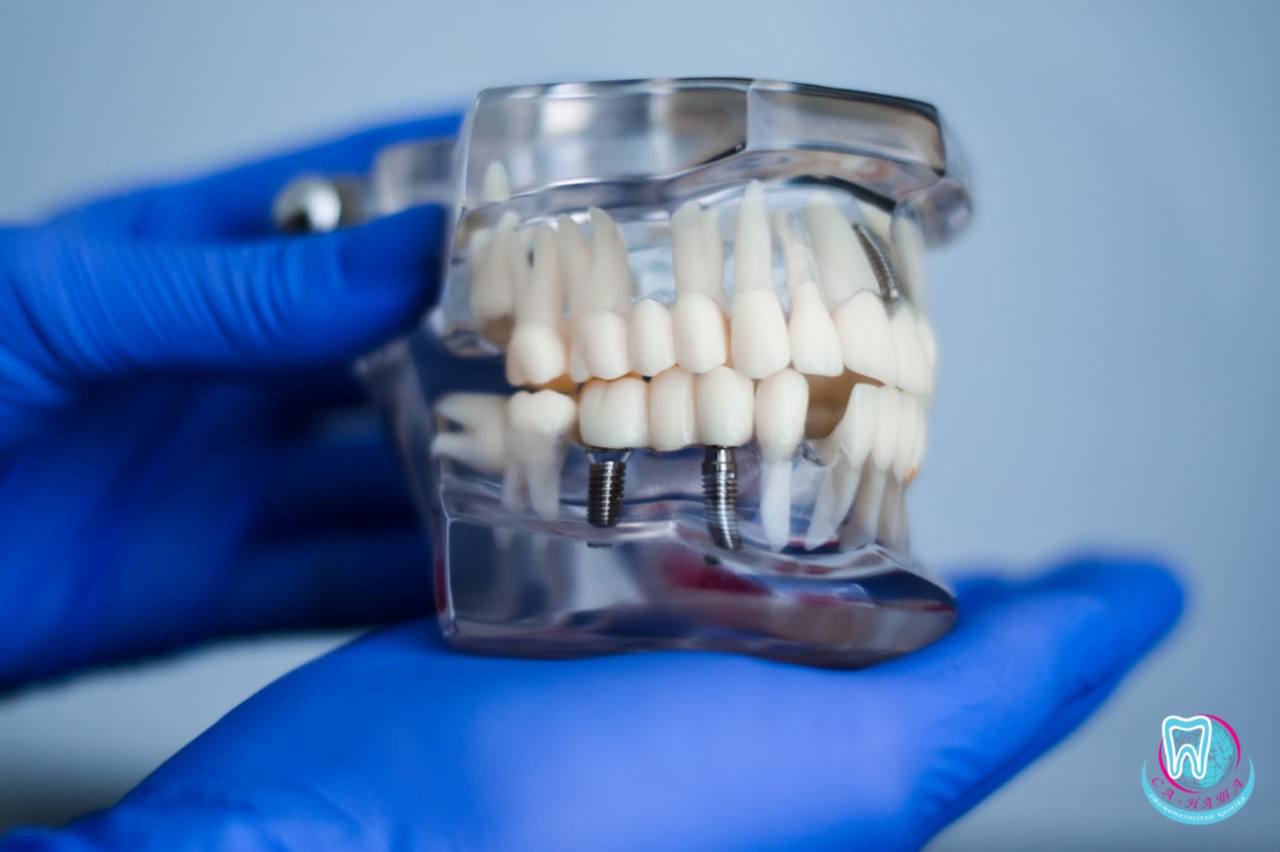 Імплантологія у сучасній стоматології
