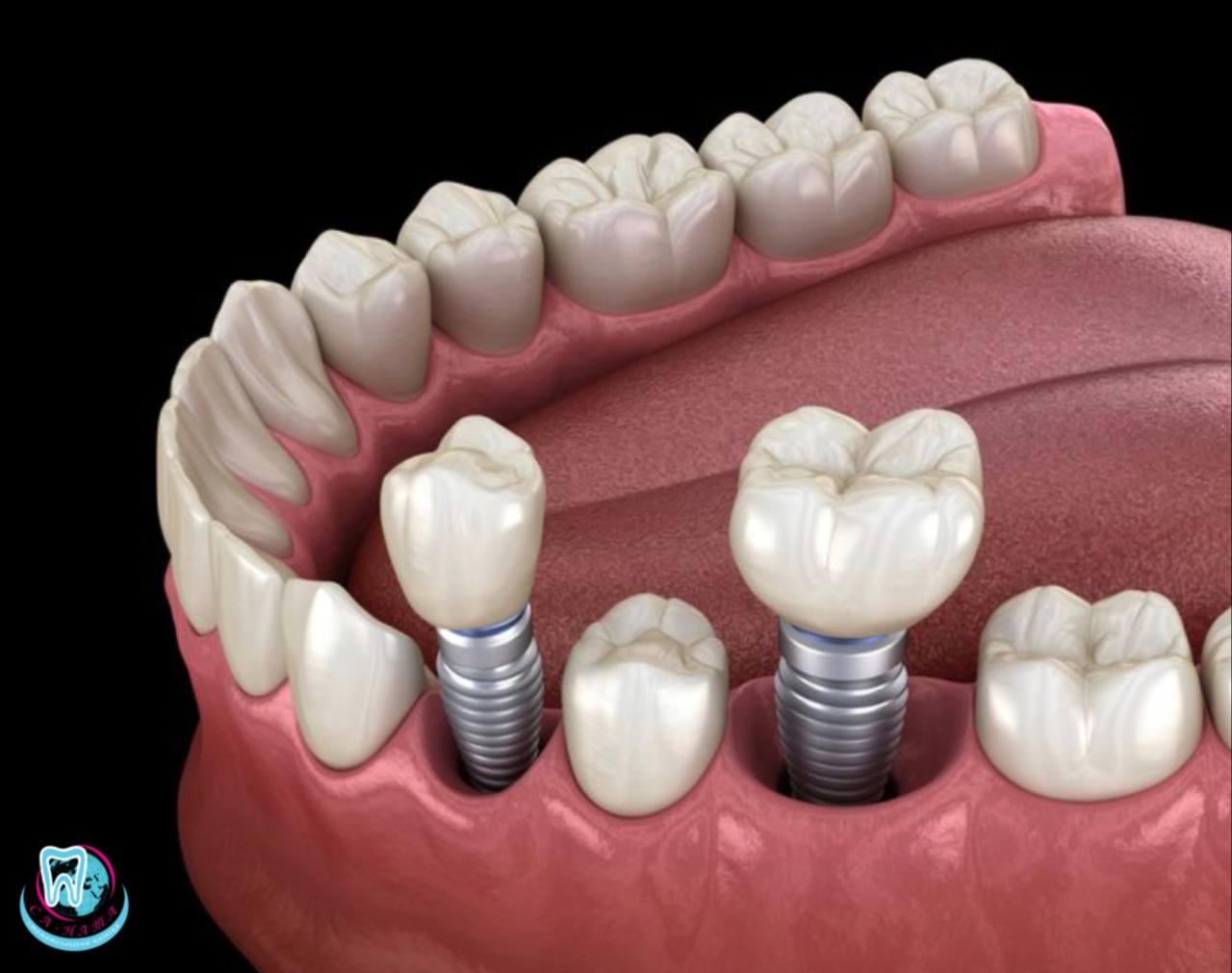 Преимущества зубных титановых имплантов