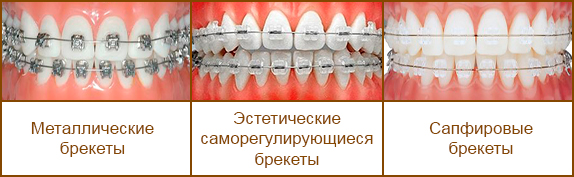Цветные брекеты – модный тренд для тинейджеров