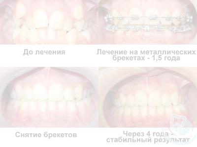 От чего зависит срок ношения брекетов?