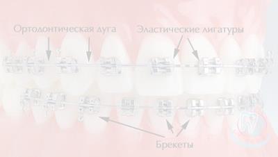 Как устанавливаются брекеты?