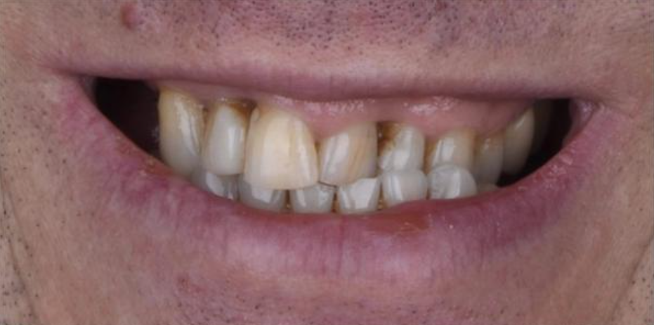 До имплантации зубов