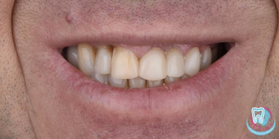 Улыбка после имплантации зубов