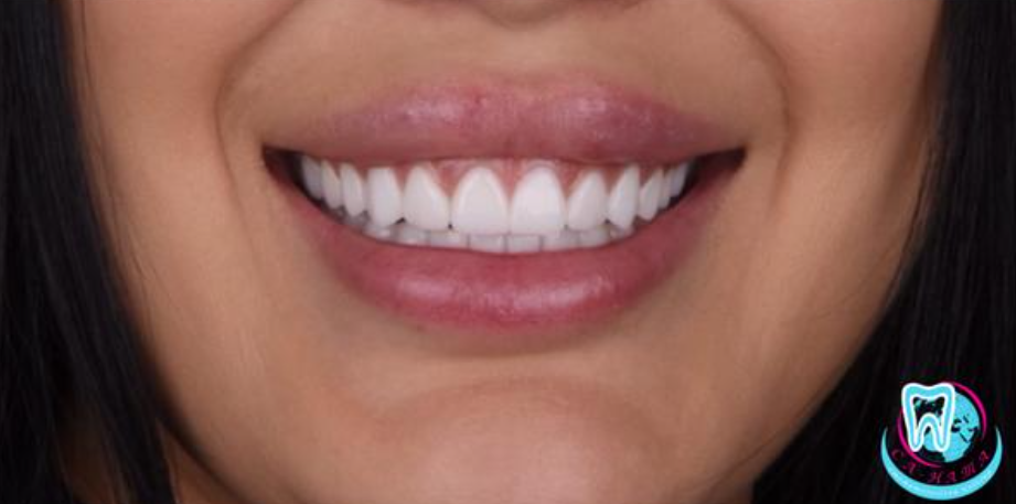 После установки керамических виниров E-max