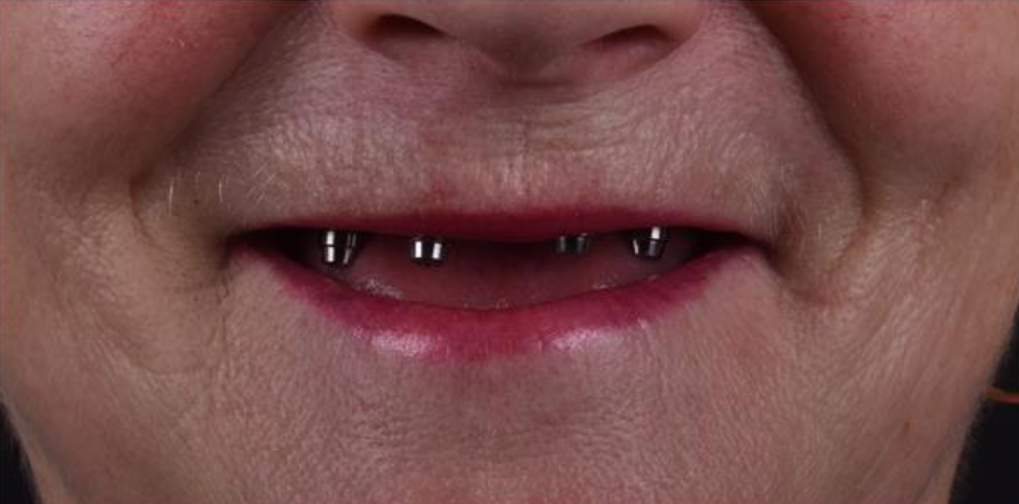 Протезирование на 4 имплантатах