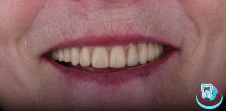 Протезирование на 4 имплантатах