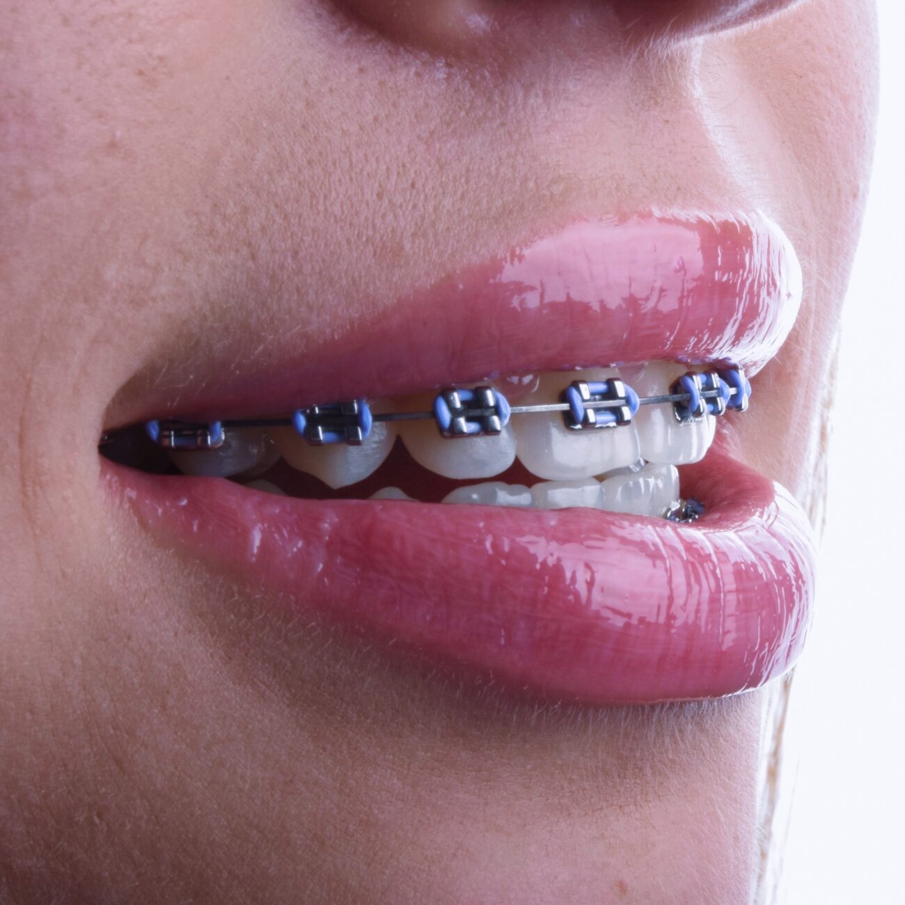 Как правильно ухаживать за брекетами