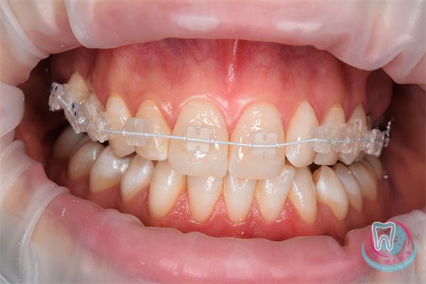 Секрет яркой улыбки - брекеты!