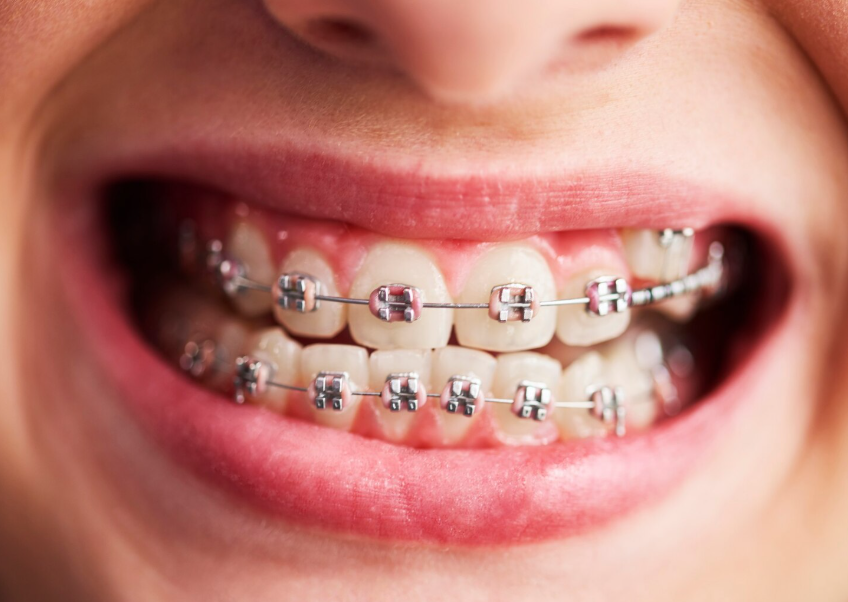 Брекеты керамические