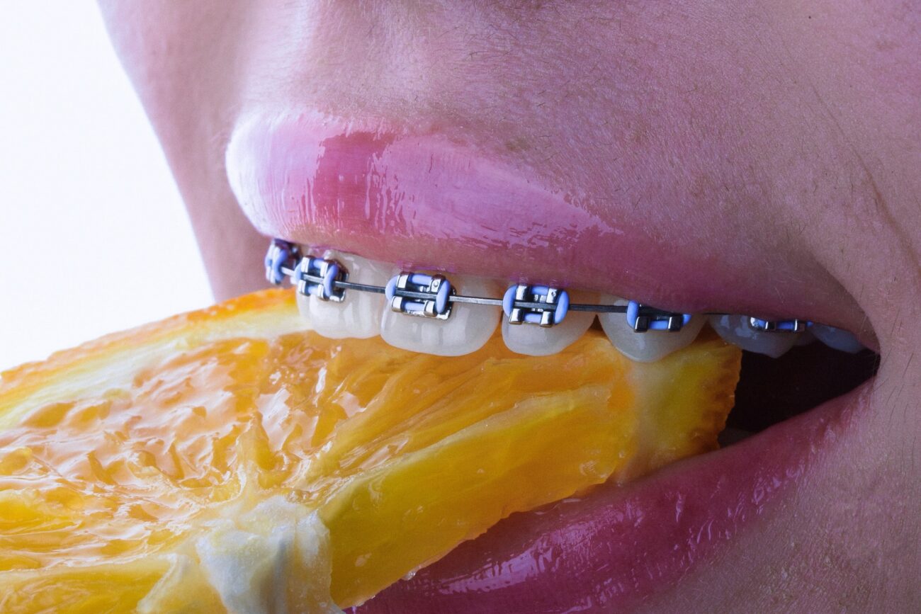 Сапфировые брекеты