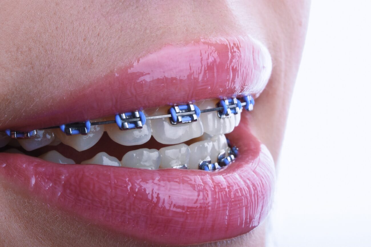 Что такое брекеты?