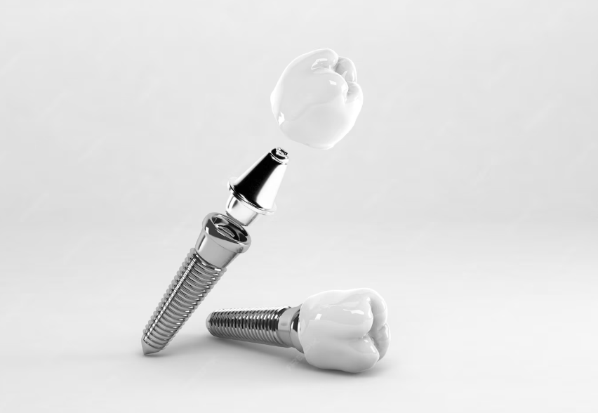 Одномоментная имплантация зуба – титановые зубные имплантаты с коронкой для моментального восстановления зубов в клинике СА-НАТА