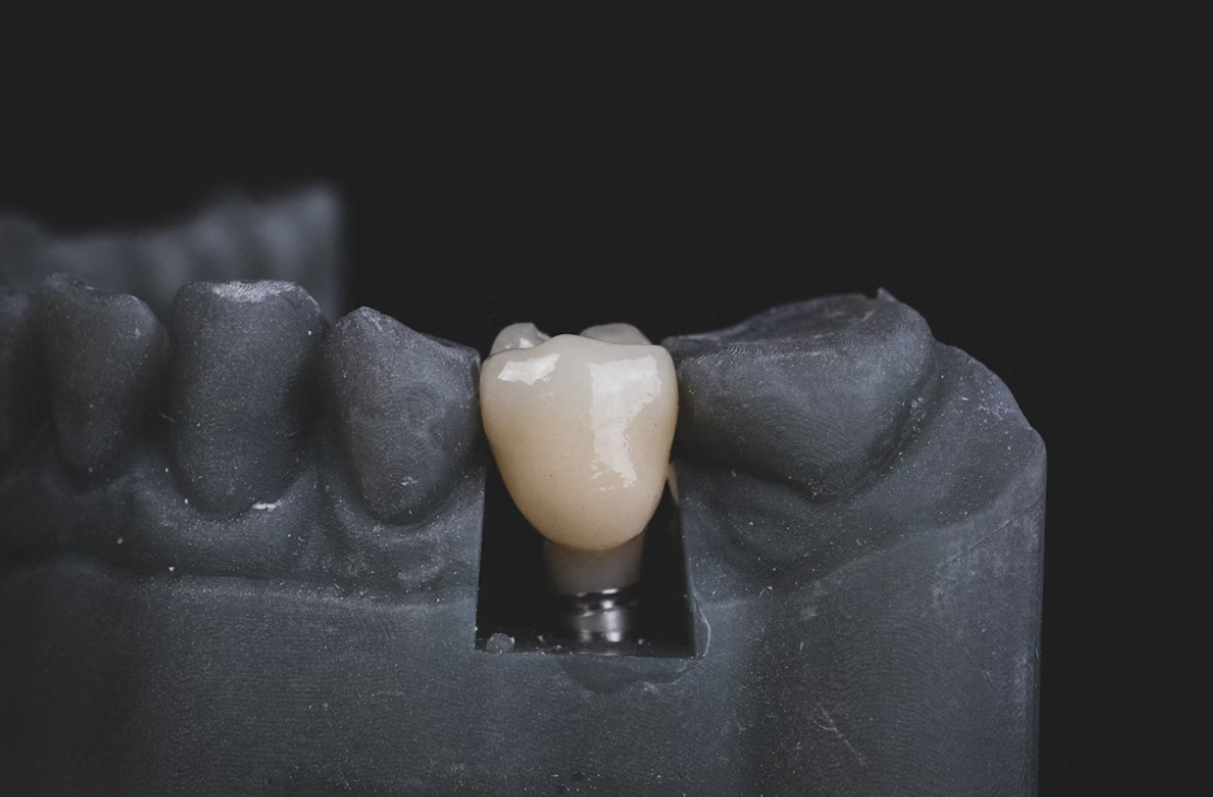 Зубной имплант с коронкой на модели челюсти — протезирование зубов на имплантатах в клинике СА-НАТА