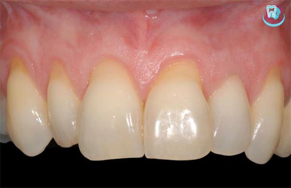 рецессия десны.