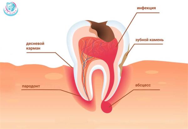 Периодонтит