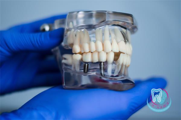 Все о зубных коронках