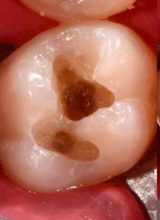 Зуб до реставрации