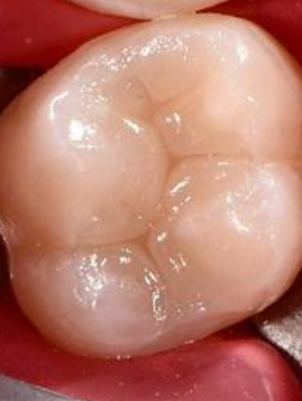 Зуб после реставрации