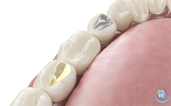 Фотополимерная пломба